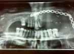 Liese Healing's jaw