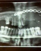 Liese Healing's jaw