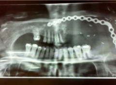 Liese Healing's jaw